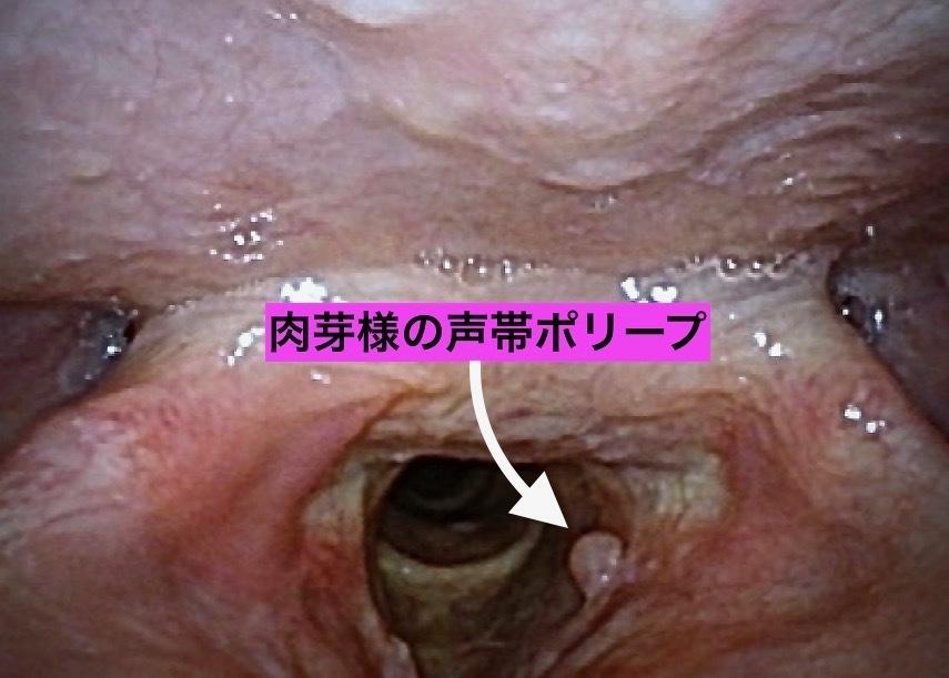 喉頭ポリープ.jpg