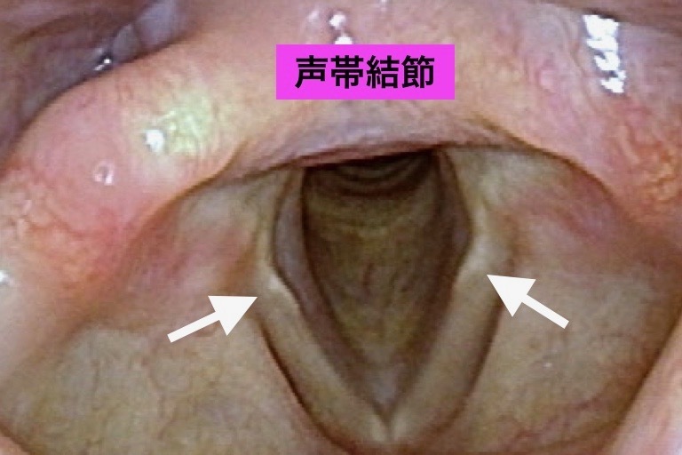 声帯結節2.jpg